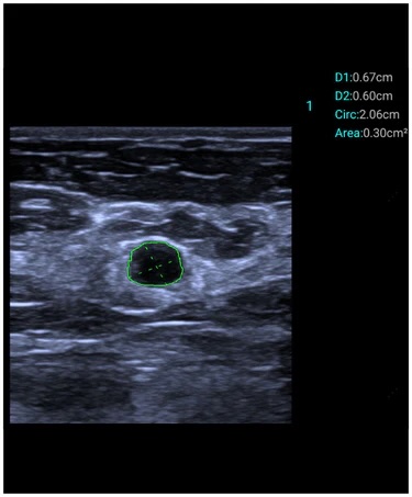 Mindray TE-Air håndholdt ultralyd